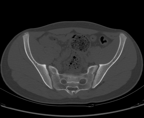 File:Aneurysmal bone cyst of ischium (Radiopaedia 25957-26094 Axial bone window 29).png
