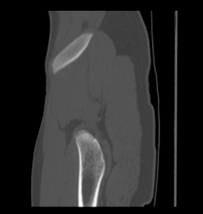 Aneurysmal bone cyst of ischium (Radiopaedia 25957-26094 Sagittal bone window 65).png