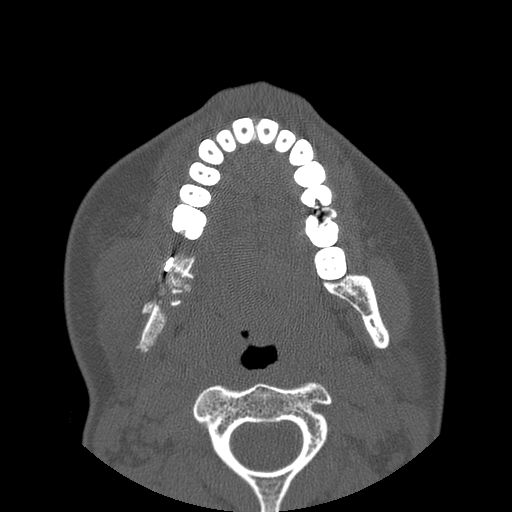 Aneurysmal bone cyst of the mandible (Radiopaedia 43280-46823 Axial bone window 67).jpg