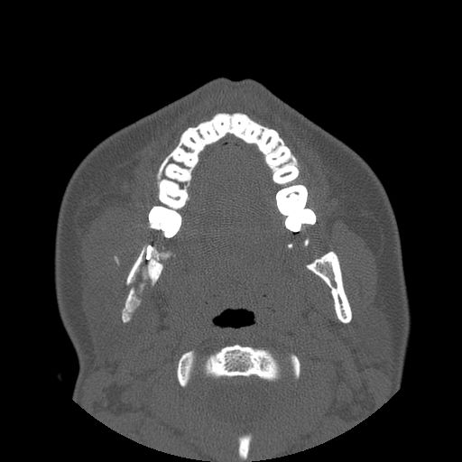 Aneurysmal bone cyst of the mandible (Radiopaedia 43280-46823 Axial bone window 77).jpg