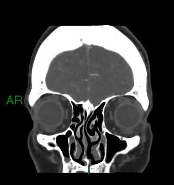 File:Aneurysmal subarachnoid hemorrhage with intra-axial extension (Radiopaedia 84371-99732 C 84).jpg