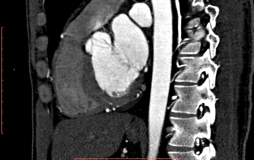 File:Anomalous left coronary artery from the pulmonary artery (ALCAPA) (Radiopaedia 70148-80181 C 136).jpg