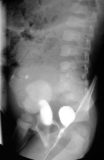 File:Anorectal malformation (Radiopaedia 24364-24654 Lateral 1).jpg