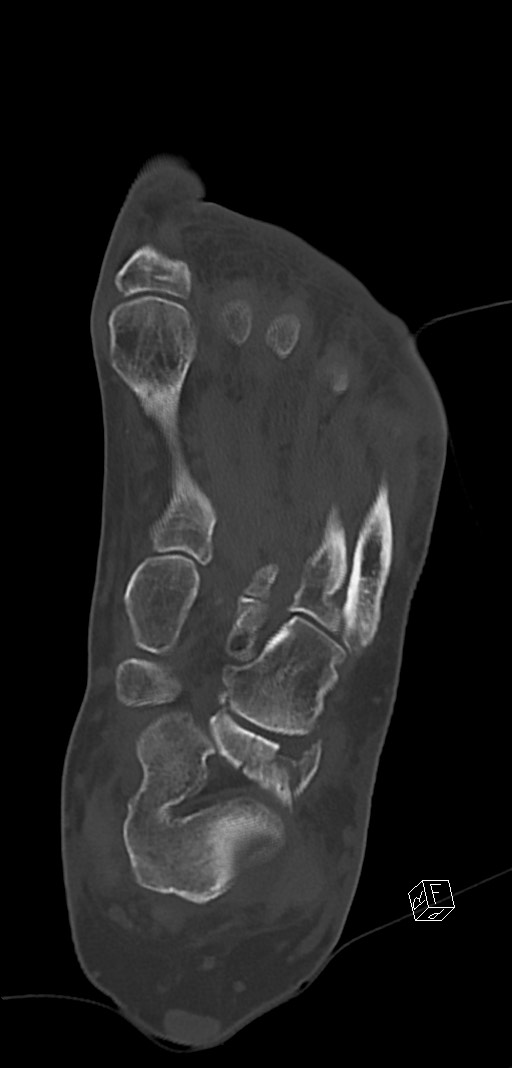 Anterior calcaneal process fracture (Radiopaedia 63353-71943 Coronal bone window 27).jpg