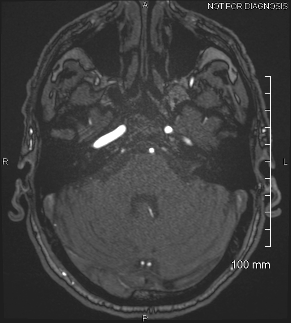 Anterior cerebral artery aneurysm (Radiopaedia 80683-94127 Axial MRA 54).jpg
