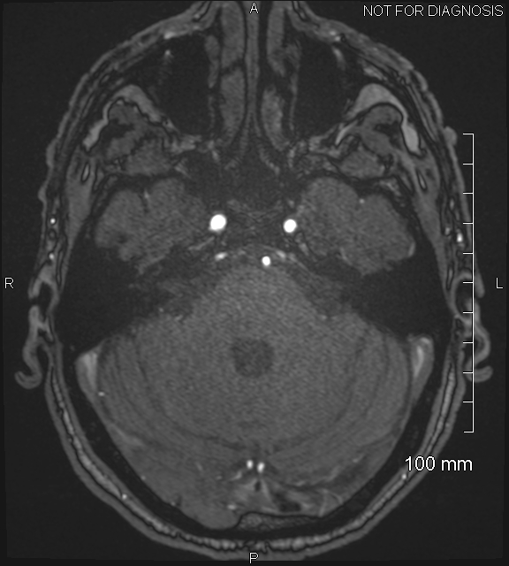 Anterior cerebral artery aneurysm (Radiopaedia 80683-94127 Axial MRA 59).jpg