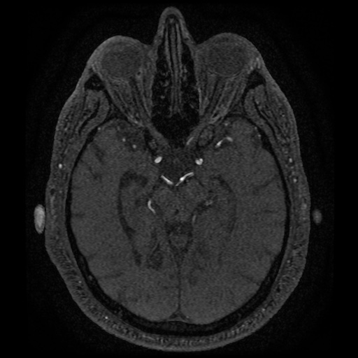 Anterior cerebral artery infarction (Radiopaedia 46794-51323 Axial MRA 80).jpg