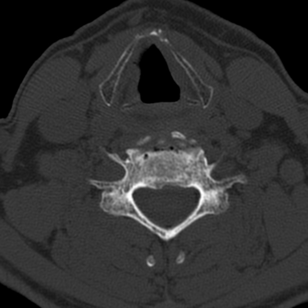 Anterior cervical postdiscectomy arthrodesis (Radiopaedia 32678-33646 Axial bone window 49).jpg