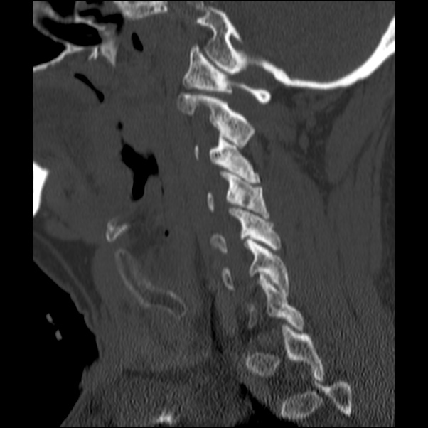 Anterior cervical postdiscectomy arthrodesis (Radiopaedia 32678-33646 Sagittal bone window 22).jpg