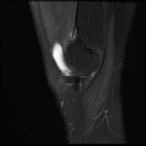 File:Anterior cruciate ligament avulsion fracture (Radiopaedia 58939-66193 Sagittal PD fat sat 19).jpg