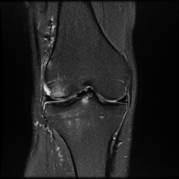 File:Anterior cruciate ligament graft tear and bucket-handle tear of medial meniscus (Radiopaedia 75867-87254 Coronal PD fat sat 12).jpg