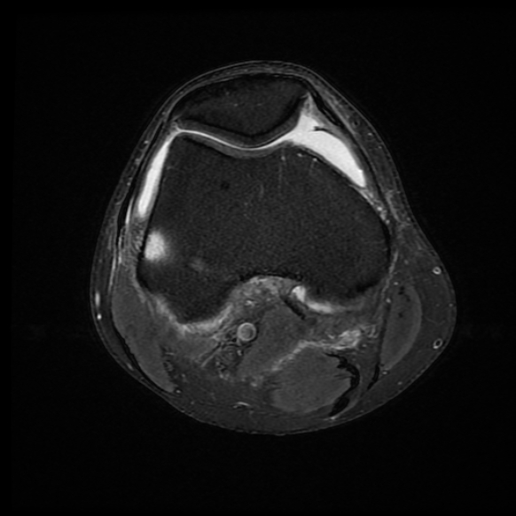 File:Anterior cruciate ligament graft tear and bucket-handle tear of medial meniscus (Radiopaedia 75867-87255 Axial PD fat sat 16).jpg