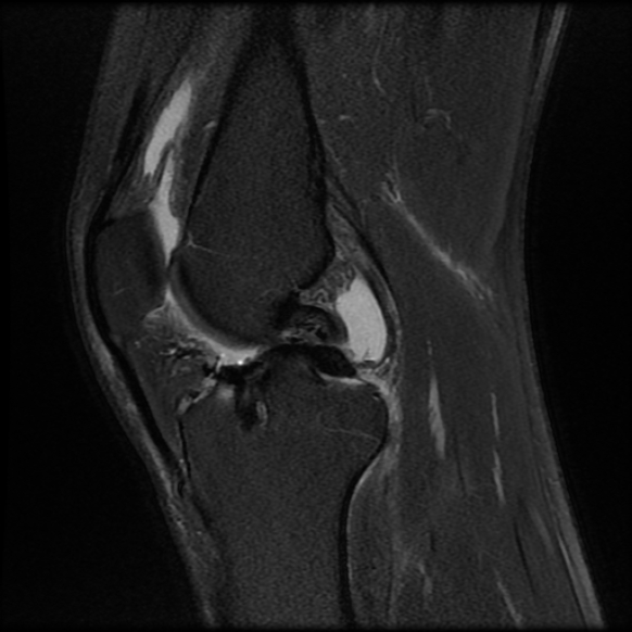 File:Anterior cruciate ligament graft tear and bucket-handle tear of medial meniscus (Radiopaedia 75867-87255 Sagittal PD fat sat 12).jpg