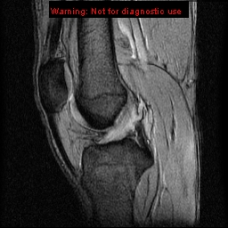 File:Anterior cruciate ligament injury - partial thickness tear (Radiopaedia 12176-12515 A 10).jpg