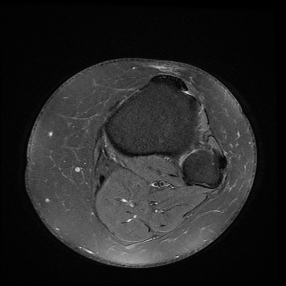 File:Anterior cruciate ligament tear, Wrisberg rip and bucket-handle tear of medial meniscus (Radiopaedia 75872-87266 Axial PD fat sat 2).jpg
