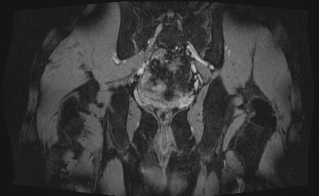 Anterior inferior iliac spine avulsion fracture (Radiopaedia 81312-95000 G 3).jpg