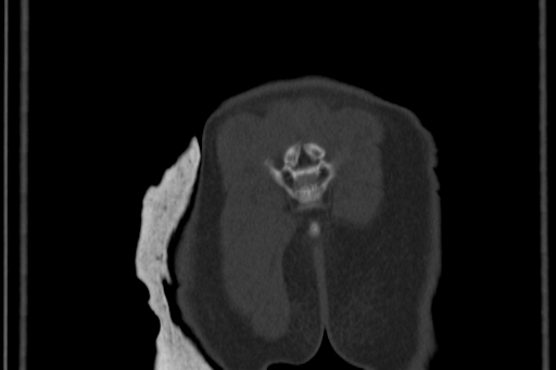 Anterior inferior iliac spine avulsion injury (Radiopaedia 88666-105376 Coronal bone window 68).jpg