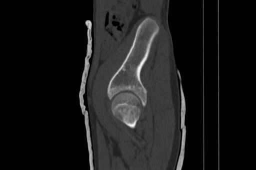 Anterior inferior iliac spine avulsion injury (Radiopaedia 88666-105376 Sagittal bone window 27).jpg