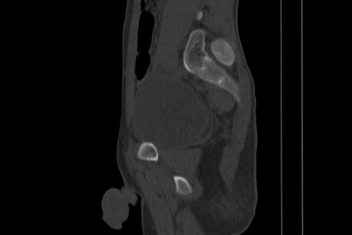 Anterior inferior iliac spine avulsion injury (Radiopaedia 88666-105376 Sagittal bone window 62).jpg