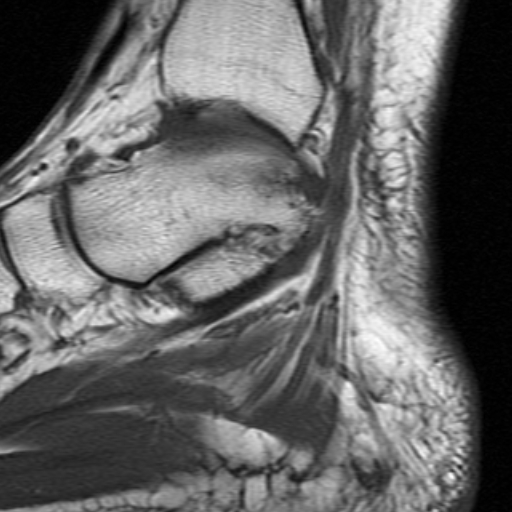 File:Anterior talofibular ligament rupture (Radiopaedia 15831-15484 Sagittal T1 14).jpg
