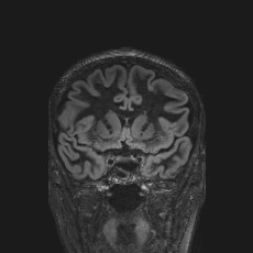 Anterior temporal encephalocele (Radiopaedia 82624-96808 Coronal FLAIR 18).jpg