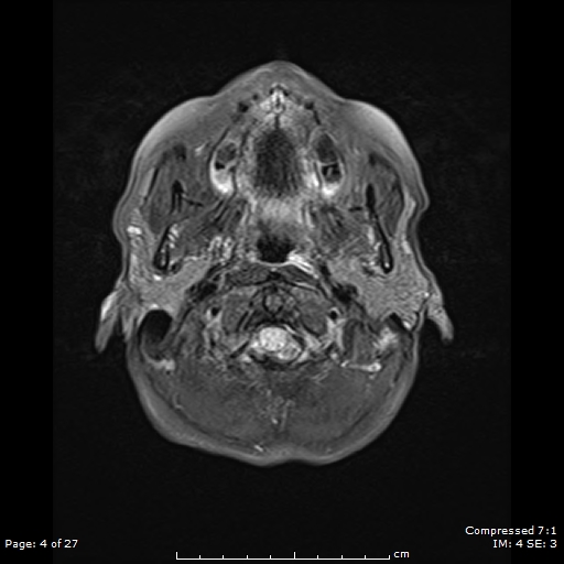 File:Anterior temporal lobe perivascular space (Radiopaedia 88283-104914 Axial FLAIR 4).jpg