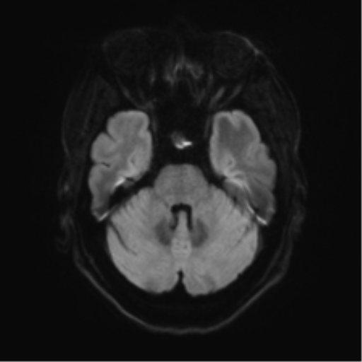 Anterior temporal pole cysts (Radiopaedia 46629-51102 Axial DWI 35).png