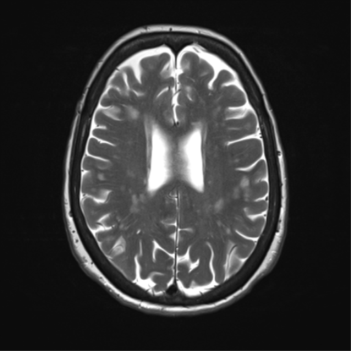 File:Anterior temporal pole cysts (Radiopaedia 46629-51102 C 25).png