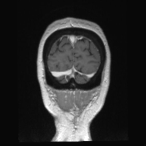 Anterior temporal pole cysts (Radiopaedia 46629-51102 Coronal T1 C+ 18).png