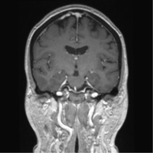 Anterior temporal pole cysts (Radiopaedia 46629-51102 Coronal T1 C+ 89).png