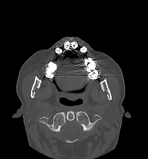 Anterior temporomandibular joint dislocation (Radiopaedia 59430-66784 Axial non-contrast 30).jpg