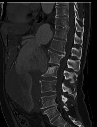 File:Anterior vertebral scalloping (abdominal aortic aneurysm) (Radiopaedia 66744-76067 Sagittal bone window 36).jpg