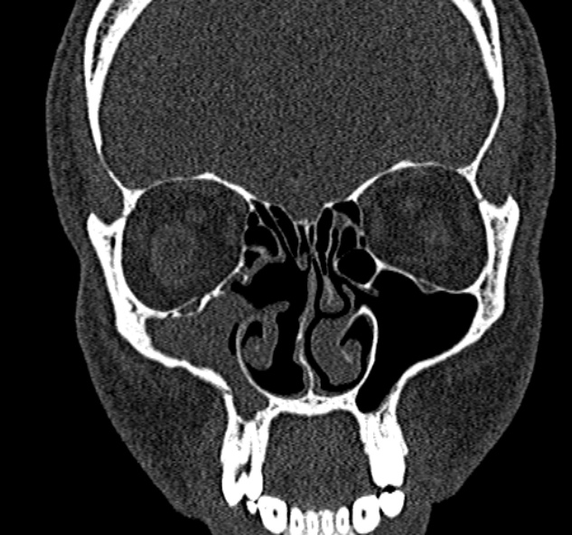 File:Antrochoanal polyp (Radiopaedia 30002-30554 Coronal bone window 32).jpg