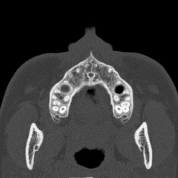 Antrochoanal polyp (Radiopaedia 33984-35202 Axial bone window 3).jpg