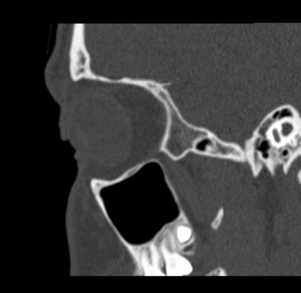 File:Antrochoanal polyp (Radiopaedia 33984-35202 Sagittal bone window 68).jpg