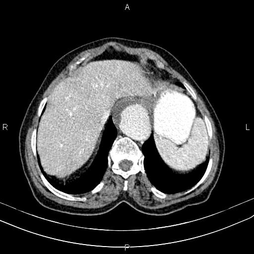 File:Aortic aneurysm and Lemmel syndrome (Radiopaedia 86499-102554 A 15).jpg