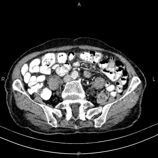File:Aortic aneurysm and Lemmel syndrome (Radiopaedia 86499-102554 A 54).jpg