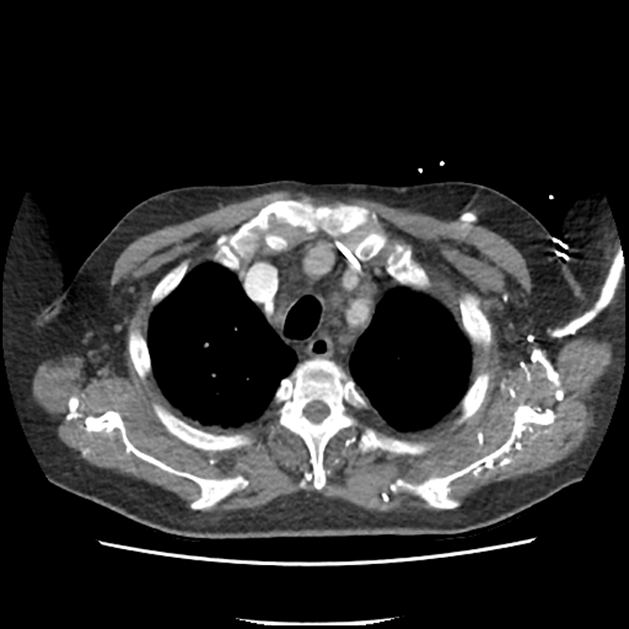 Aortic arch graft infection (FDG PET-CT) (Radiopaedia 71975-82437 A 8).jpg