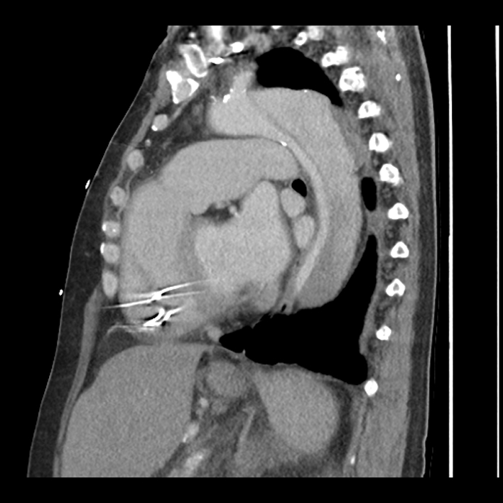 Aortic arch graft infection (FDG PET-CT) (Radiopaedia 71975-82437 C 42).jpg