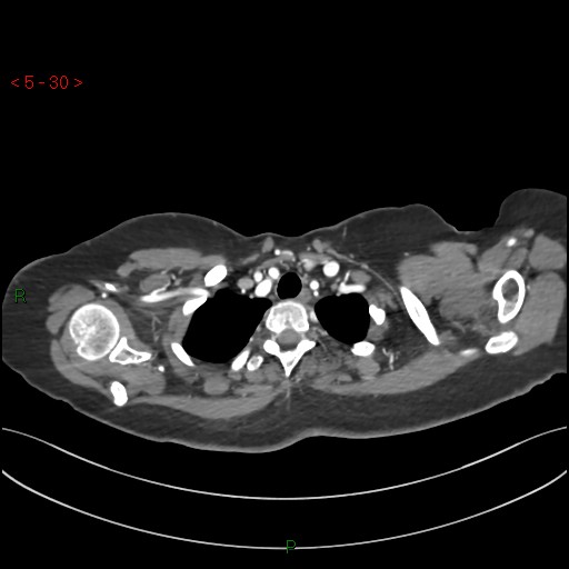 File:Aortic arch origin of left vertebral artery (Radiopaedia 51520-57286 A 29).jpg