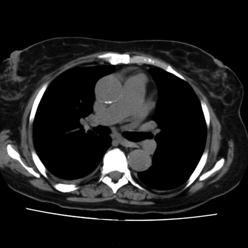 Aortic arch pseudoaneurysm (Radiopaedia 8534-9368 Axial non-contrast 34).jpg