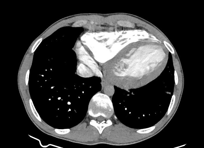 File:Aortic coarctation with aneurysm (Radiopaedia 74818-85828 A 62).jpg