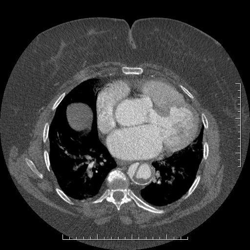 File:Aortic dissection- Stanford A (Radiopaedia 35729-37268 A 59).jpg