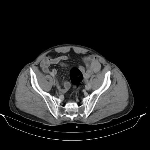 File:Aortic dissection- Stanford type A (Radiopaedia 22085-22085 Axial C+ delayed 43).jpg