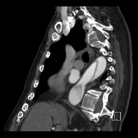 Aortic dissection (CTPA) (Radiopaedia 75506-86750 C 46).jpg