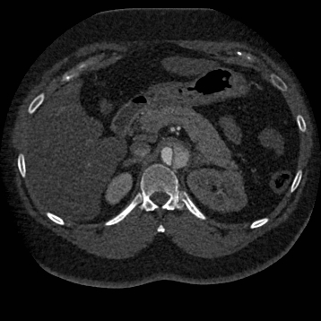 Aortic dissection (Radiopaedia 57969-64959 A 343).jpg