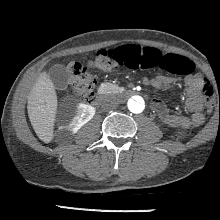 Aortic dissection - DeBakey Type I-Stanford A (Radiopaedia 79863-93115 A 55).jpg
