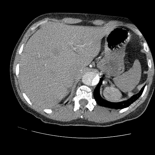 File:Aortic dissection - Stanford A -DeBakey I (Radiopaedia 28339-28587 B 102).jpg