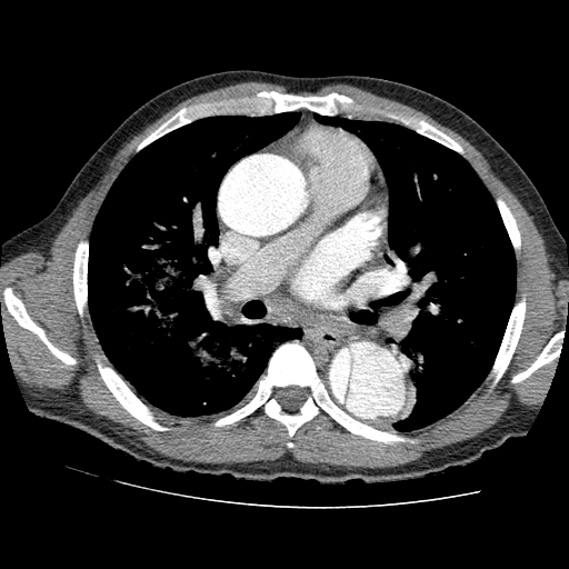 File:Aortic dissection - Stanford A -DeBakey I (Radiopaedia 28339-28587 B 42).jpg