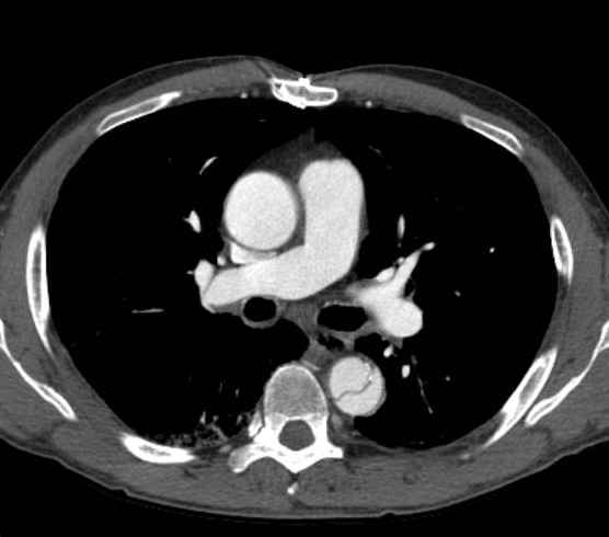 File:Aortic dissection - Stanford type B (Radiopaedia 73648-84437 A 45).jpg